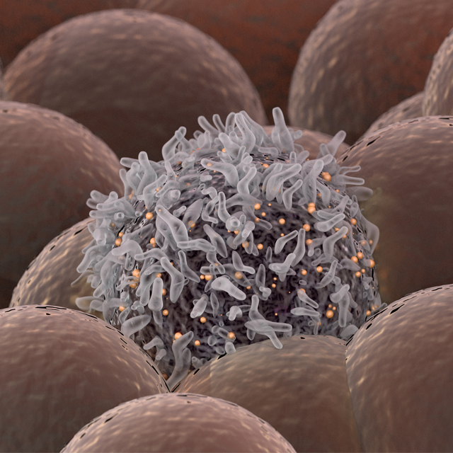 gastro-cancer-640