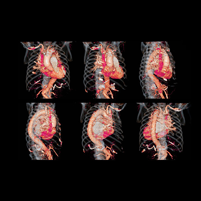 A graphic shows a compilation of aortic illustrations.