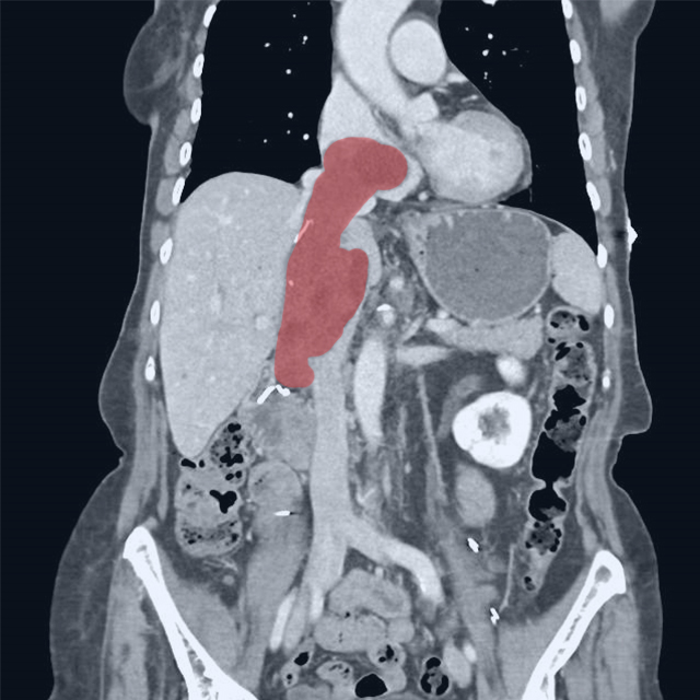 A CT scan shows a large mass, highlighted in red, extending from outside the vena cava where the right renal vein used to be, into and up through the cava and into the heart