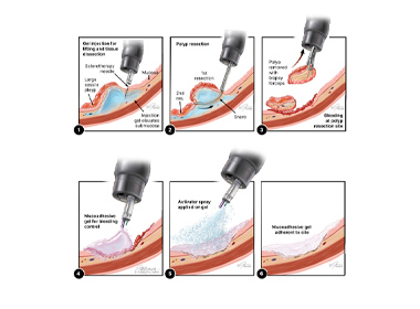 Illustration shows step-by-step process for applying the gel. 