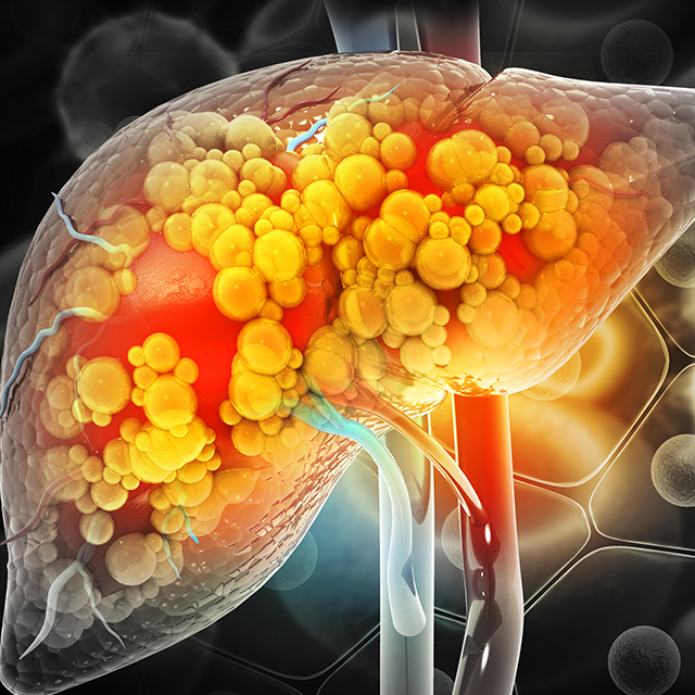 Illustration of a diseased liver