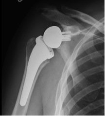 x-ray of reverse total shoulder replacement