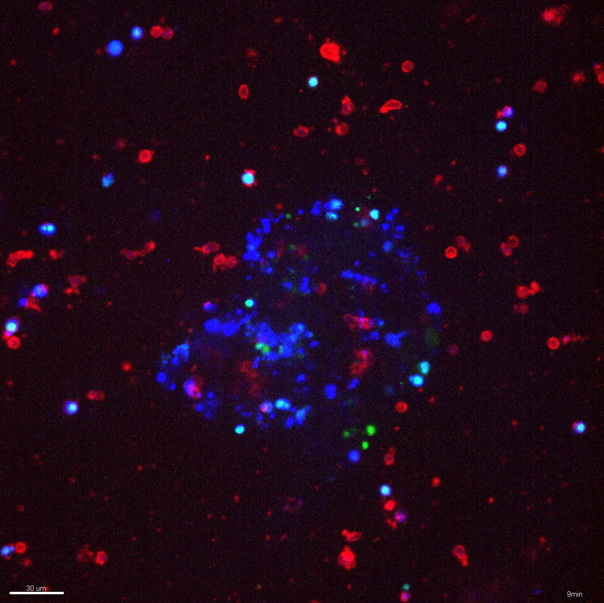 A blue tumor organoid surrounded by red NK cells