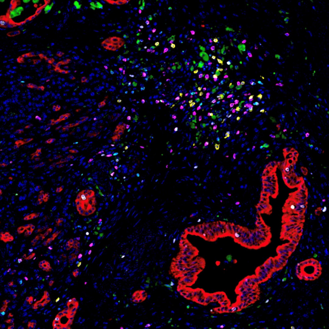 Fluorescent image of immune cells clustered around pancreatic cancer cells