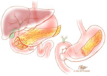 surgical diagram of pancreas