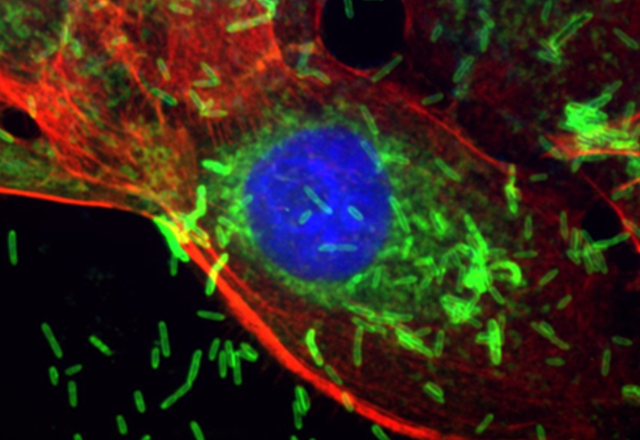 Breast cell with mutant BRCA1 harboring f. nucleatum. Green is staining the bacteria. Blue stain is showing the nucleus of the cell. Red stain is showing the actin filaments of the cell structure