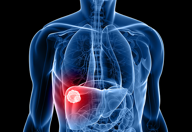 This image is a medical illustration depicting liver cancer, a disease where cells in the liver grow out of control. 