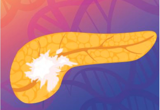 A medical illustration of a pancreas with a tumor, against a background of DNA strands, which is a representation of pancreatic cancer.  Credit: Carolyn Hruban
