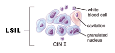 Illustration of LSIL cells.
