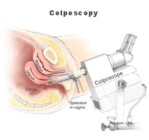 Cervical colposcopy illustration
