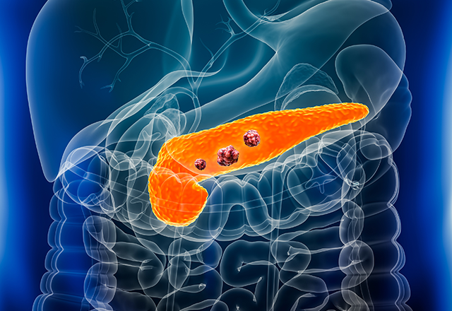 Transparent human torso showing an orange pancreas with tumors, against a blue background. The image highlights pancreas location and health concerns.