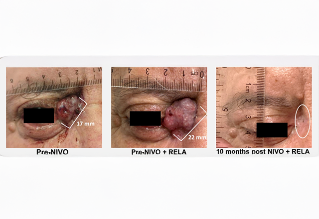 The image shows three photos of a patient's eye area marked with a ruler. Each photo tracks lesion size reduction over time with a labeled treatment timeline.