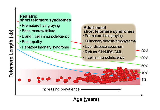 Distinct pediatric and adult presentations of short telomere syndromes. The severity of the telomere length defect determines the age of onset and common presenting symptoms.  Individuals with symptoms in childhood have a more severely shortened telomere length than those who develop symptoms in later adulthood.  The adult-onset short telomere syndrome is the more common presentation and accounts for >90% of individuals diagnosed with short telomere syndromes. CH stands for clonal hematopoiesis, MDS for myelodysplastic syndrome and AML for acute myeloid leukemia. Infographic from: Mary Armanios The Role of Telomeres in Human Disease. Annu Rev Genomics Hum Genet. 2022