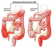 Anatomic distribution of Crohn’s disease and ulcerative colitis.
