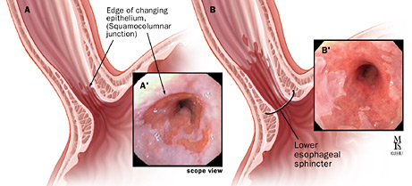 A: Short-segment and B: Long-segment Barrett’s esophagus; A’ and B’: Endoscopic views