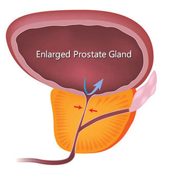 Diagram of an enlarged prostate gland, showing the prostate gland compressing the urethra and blocking the flow of urine from the bladder