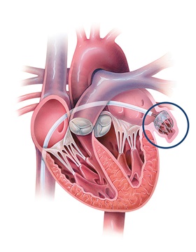 Diagram of the heart with the WATCHMAN device inserted into the left atrial appendage