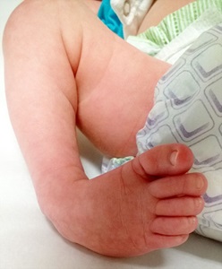 clubfoot is a common condition where an infant is born with a foot that turns in
