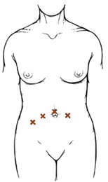 Diagram of laparoscopic incision, showing four small spots across the abdomen