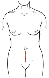 Diagram of lower midline incision, showing a vertical line down the abdomen to the groin