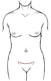 Diagram of Pfannenstiel incision, showing a horizontal line across the groin