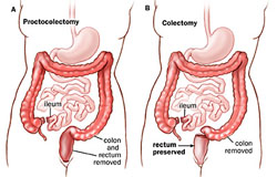 Comparison of proctocolectomy and colectomy surgical procedures