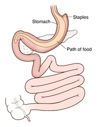 Front view of stomach showing vertical sleeve gastrectomy. Arrows show path of food and digestive fluids.