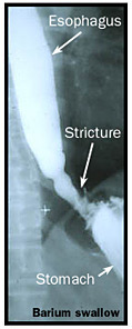 Barium swallow image showing a stomach stricture.