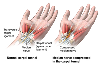 Hand and wrist showing a normal carpal tunnel and the compressed median nerve in an inflamed carpal tunnel.