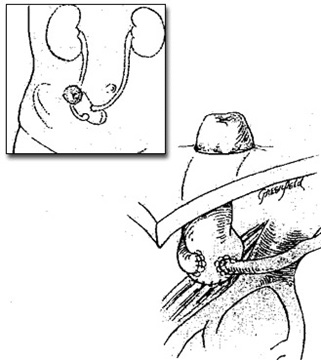 Illustration showing inside and outside views of an ileal conduit.
