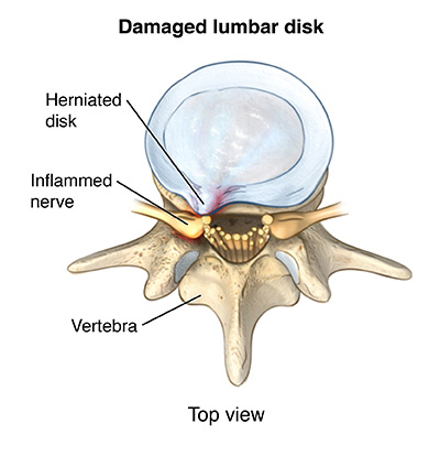 How a damaged lumbar disc can press on nerve roots and cause radiculopathy
