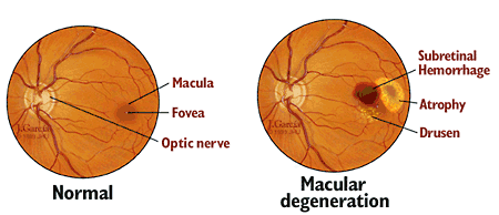 Age Related Macular Degeneration Eye Chart