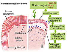 Mechanism of injury in collagenous colitis.