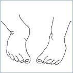 Illustration showing feet turned inward