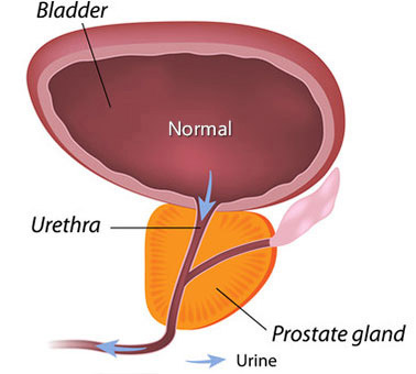 Diagram of a regular prostate gland, showing the free flow of urine from the bladder into the urethra and past the prostate gland