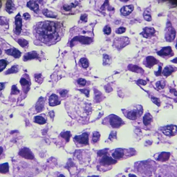 Osteosarcoma cells shown under a microscope