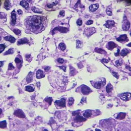 Sarcoma Example Soft Tissue Sarcomas | Johns Hopkins Medicine