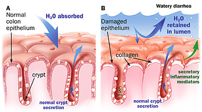 Pathogenesis of diarrhea in collagenous and lymphocytic colitis; A: normal epithelium; B: damaged epithelium.