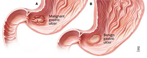 Peptic ulcers; A: Malignant; B: Benign