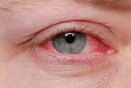 Eye infected with Pink Eye