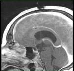 Side view MRI of craniopharyngioma after orbitozygomatic craniotomy