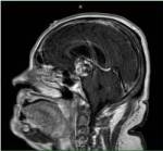 Side view MRI of craniopharyngioma before surgery
