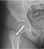 X-ray showing a screw in surgical treatment of slipped capital femoral epiphysis