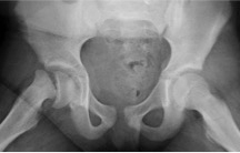 X-ray showing slipped capital femoral epiphysis of the right hip