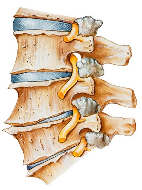 Spinal Arthritis (Arthritis in the Back or Neck) | Johns Hopkins Medicine
