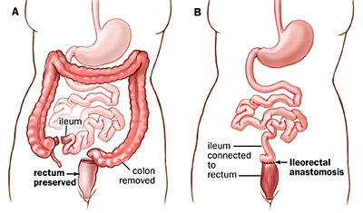 Technique for colectomy with ileorectal anastomosis (Click to Enlarge)