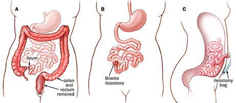 Technique for total proctocolectomy with Brook ileostomy (front and side views)
