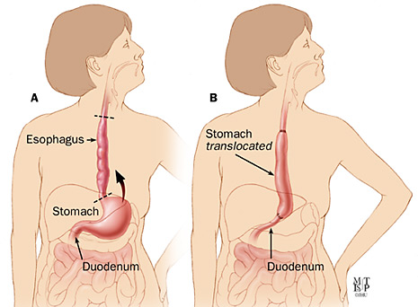 Technique for transhiatal esophagectomy; A: removal of the esophagus; B: translocation of the stomach (click to enlarge)