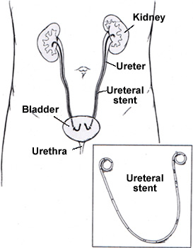 Illustration of a ureteral stent linking the kidneys to the bladder
