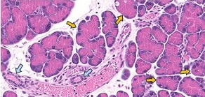 Cancer
